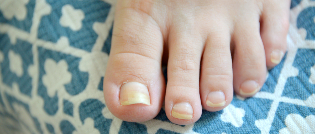 Don’t Bury Your Toes in the Sand This Summer Tips to Fight Toenail Fungus Lancaster General